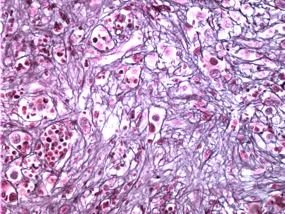 Reticulin stain shows marked (3+) reticulin fibrosis.